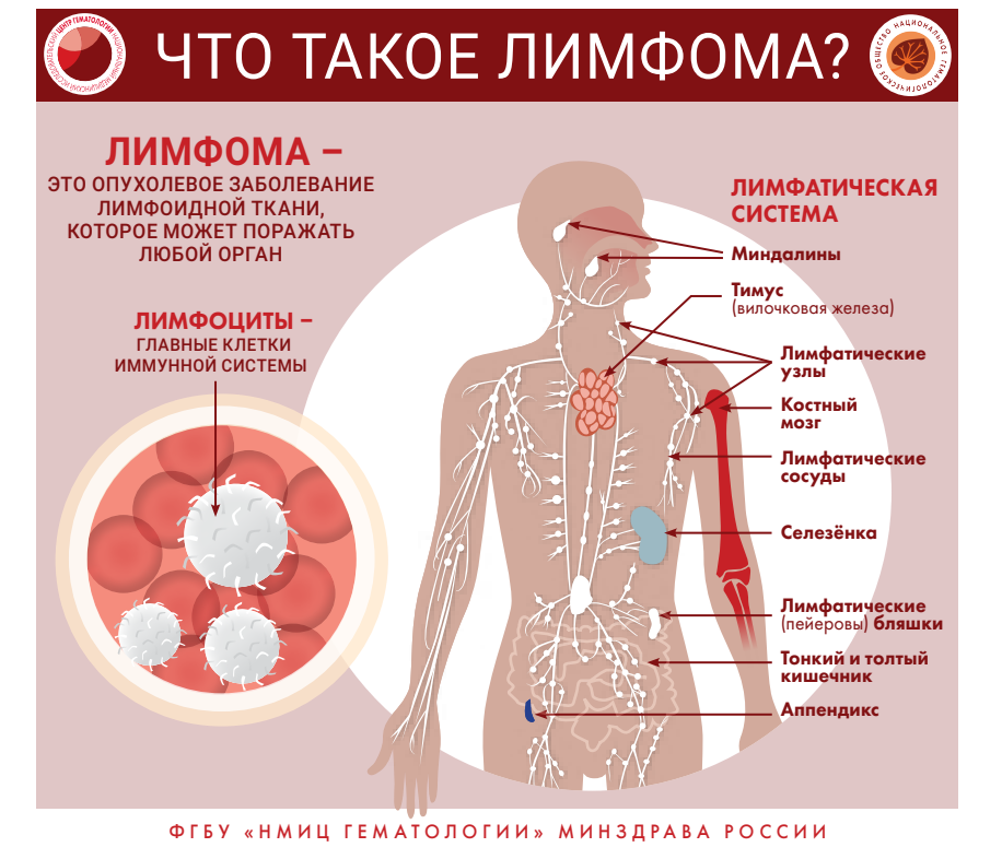 Признаки и симптомы неходжкинской лимфомы